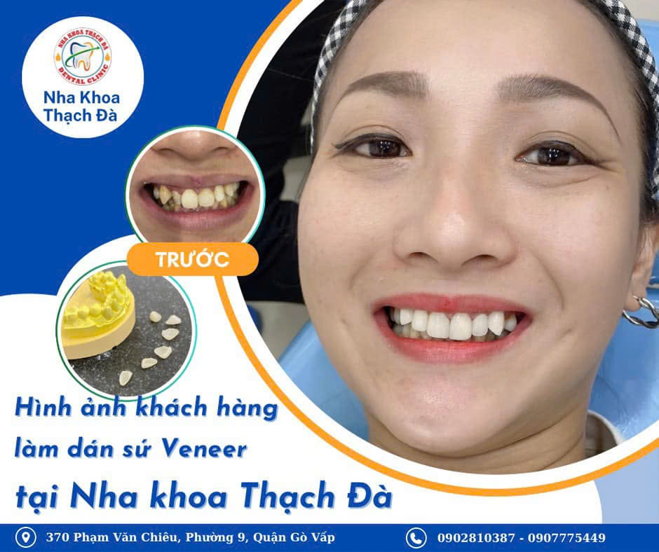 Mặt dán sứ VENEER