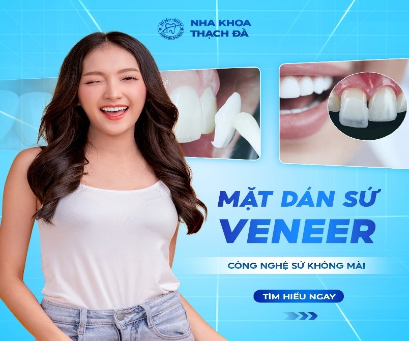 MẶT DÁN SỨ VENEER