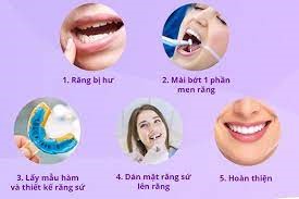 MẶT DÁN SỨ VENEER